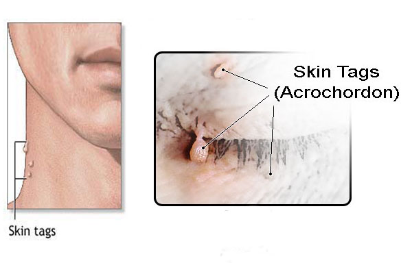 Removal Of Skin Tags